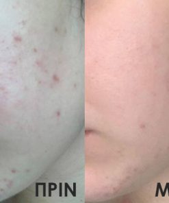 Πριν και μετά-ακμη