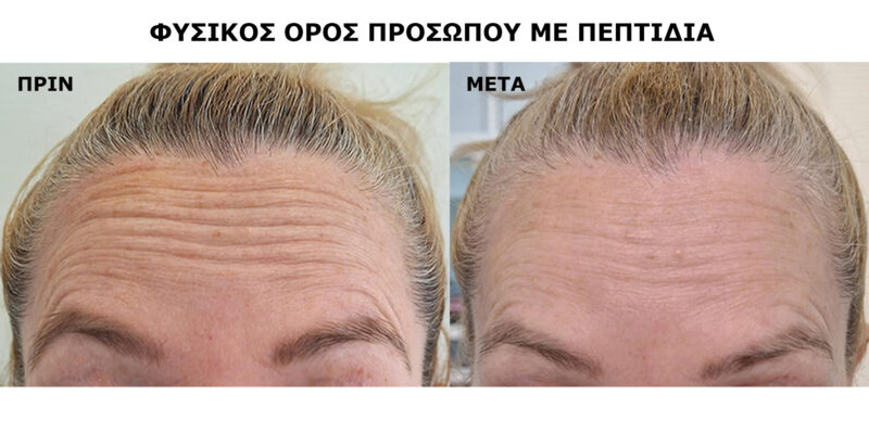 ΡΥΤΙΔΕΣ ΣΤΟ ΜΕΤΩΠΟ