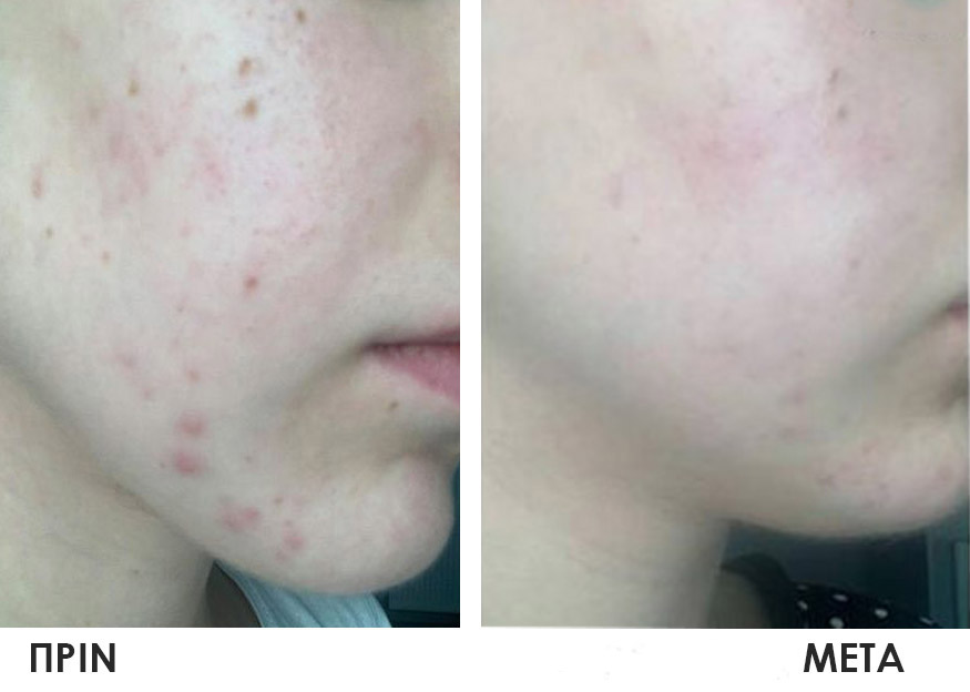 Ακμή και Σημάδια Ακμής - Image 5