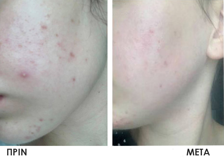 Ακμή και Σημάδια Ακμής - Image 6