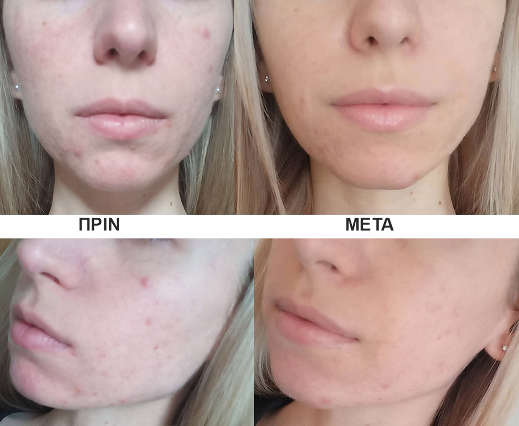 Ακμή και Σημάδια Ακμής - Image 3