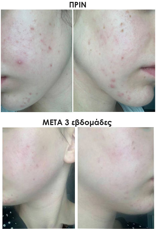 Ακμή και Σημάδια Ακμής - Image 4