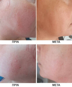 ροδοχρους ακμη πριν και μετα