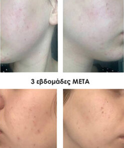 κοκκινίλες προσωπου πριν και μετά