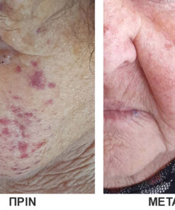 ΑΙΜΑΤΩΜΑΤΑ ΠΡΟΣΩΠΟ ΠΡΙΝ ΚΑΙ ΜΕΤΑ