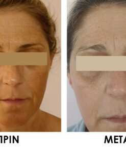 πανάδες προσώπου. φωτογραφίες πριν και μετά