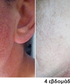 ευρυαγγείες προσώπου πριν και μετά